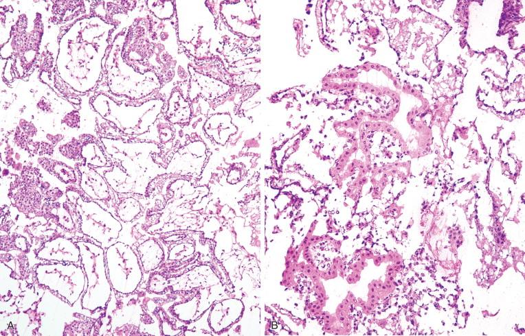 Figure 18-1, When the pathologist is asked to evaluate for the presence of villi at frozen section, it is important to be aware of the prominent freezing artifact associated with the tissue. Only when classic villi are identified on microscopic examination (if gross examination failed to confirm them), the diagnosis of “positive” should be rendered (A). Sometimes a tangential section of hypersecretory endometrial epithelium may closely mimic the appearance of villi; however, the dual population of cyto- and syncytiotrophoblast is not present (B).