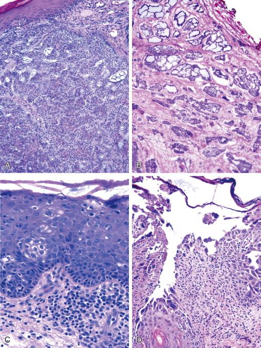 Figure 18-2, A, Basal cell carcinoma is uncommon in the vulva but in frozen section may mimic a squamous cell carcinoma, the most common carcinoma at this site.