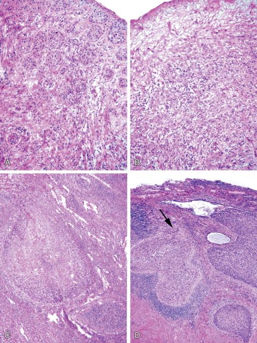 Figure 18-3, A, Squamous cell carcinoma in situ involving adnexal structures of the vulva. Notice the rounded contours of the nest.