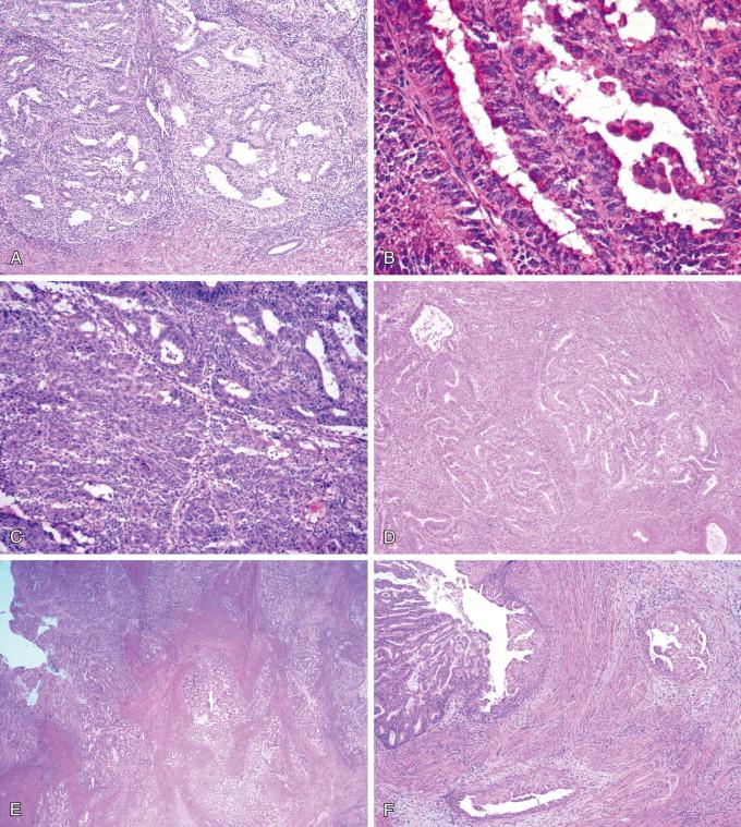 Figure 18-5, A, When evaluating depth of invasion in a frozen section, the pathologist should be mindful of the irregular endomyometrial junction. Even though a nodular pushing growth of endometrial carcinoma is seen, notice the presence of preexisting endometrial glands at a lower level indicative that the carcinoma is confined to the endometrium.