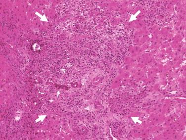 Figure 14-1, Low-power view of enlarged portal tract (between large arrows) with changes of large duct obstruction—edema, inflammation, and ductular reaction in a case of common bile duct obstruction by adenocarcinoma of head of pancreas. The enlarged portal area appeared as a white subcapsular “area or nodule” at laparotomy. The ductular structures (small arrows) that comprise the ductular reaction need to be distinguished from metastatic adenocarcinoma.