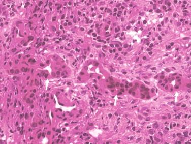 Figure 14-2, High-power view of same portal tract as Figure 14-1 . The ductular structures (arrows) are present at the periphery of the portal area, the expected location for ductular reaction pattern, they display mild cytologic atypia, and their lining cells have more or less similar nuclei— features that distinguish them from metastatic adenocarcinoma.