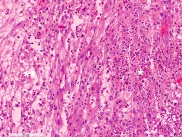 Figure 14-4, High-power view of same portal tract as in Figure 14-3 showing dilated bile duct filled with neutrophils forming an abscesslike lesion (single asterisk) and adjacent edematous portal connective tissue (double asterisk) .