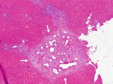 Figure 14-5, Low-power view of bile duct hamartoma (between arrows) . The lesion is composed of angulated and sometimes dilated glandular spaces. The view captures the characteristic architectural pattern.