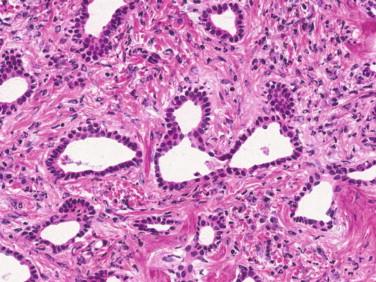 Figure 14-6, High-power view of bile duct hamartoma. The lesion is composed of angulated and sometimes dilated glandular spaces lined by benign low cuboidal epithelium.