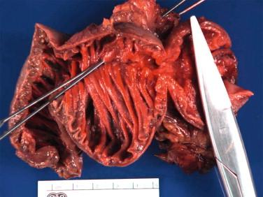 Figure 13-2, Pancreatic and bile duct resection margins can be identified by probing the ampulla.