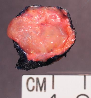 Figure 8-1, Partially cystic Warthin tumor containing mucoid material.