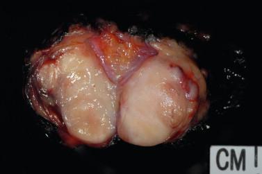 Figure 8-2, Well-circumscribed, lobulated pleomorphic adenoma.