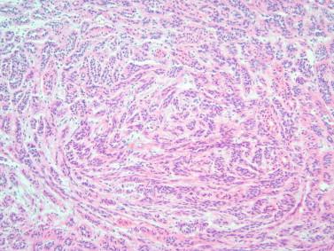 Figure 8-6, Polymorphous low-grade adenocarcinoma with an “eye-of-the-storm” architectural pattern.