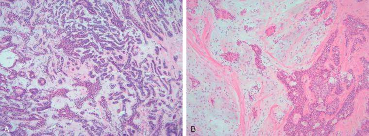 Figure 8-7, A, Pleomorphic adenoma with haphazard arrangement of the epithelial component in a background of scant stroma. B, Pleomorphic adenoma with a predominance of the classic chondromyxoid stroma.