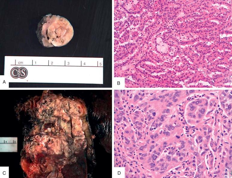 Figure 16-2, Gross of papillary renal cell carcinoma (A) . Ink is applied to the margin of resection, which is grossly distant from the margin, and should be considered negative. B, Microscopy highlights the characteristic papillary architecture, with foamy macrophages within fibrovascular stalks. C, Gross heterogeneity, necrosis, and invasiveness are characteristics of collecting duct renal cell carcinoma (RCC). D, Microscopy shows high-grade carcinoma, with pleomorphic nuclei, mitotic activity, and neutrophilic infiltration.