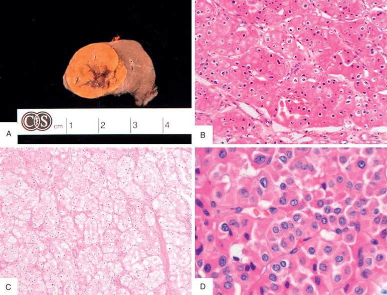 Figure 16-3, A, Gross of chromophobe renal cell carcinoma (RCC), typically expansile, noninfiltrating, and with light brown color. Frequently a central area of degeneration or scar is seen. B-D, Chromophobe RCC has prominent cell borders, with open clear cytoplasm, irregular nuclear borders, sometimes described as “raisinoid,” and binucleation. The eosinophilic variant (B, D) has pink cytoplasm with perinuclear clearing. Sheets of cells help separate from oncocytoma.