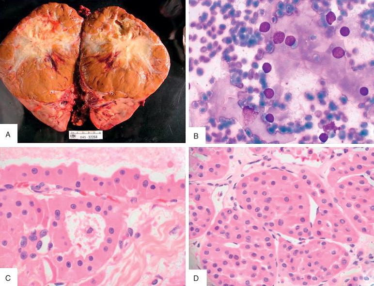 Figure 16-4, A, Oncocytoma is classically mahogany brown on gross appearance and frequently exhibits a central area of degeneration or fibrosis, features which can overlap with chromophobe renal cell carcinoma (RCC). B, Touch print cytology can highlight the abundant granular cytoplasm and uniform, round nuclei of oncocytoma. C, D, Neoplastic cells form small acinar and small solid groups, not sheets. The abundant granular cytoplasm, round nuclei, and uniformity are clues to the diagnosis.