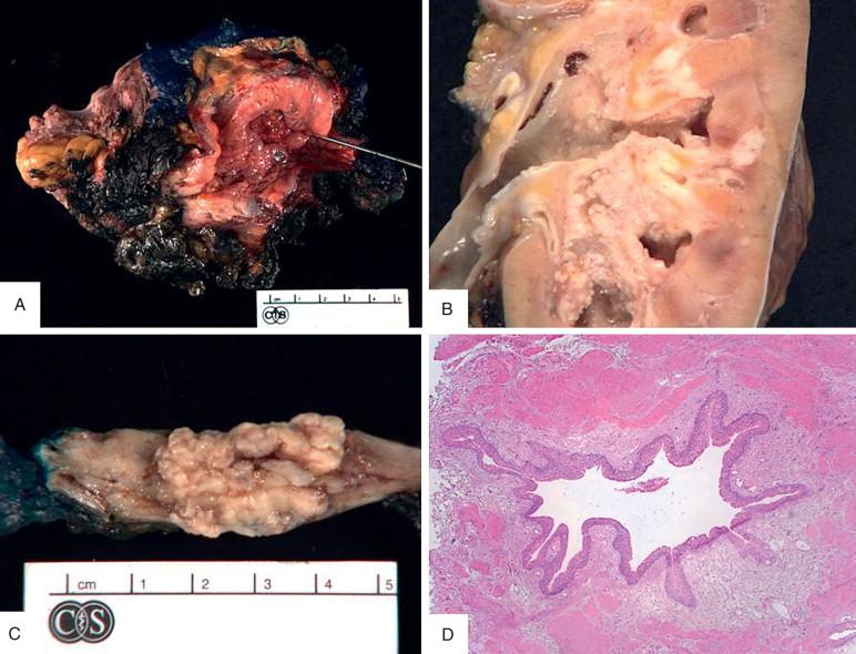Figure 16-6, In almost all cases of urothelial carcinoma resections, including bladder (A), renal pelvis (B), or ureter (C), frozen sections of ureteral margins are performed to rule out invasive or in situ carcinoma. Simple gross evaluation of margins can provide important information as to probability of involvement. Frozen section of the normal ureter should include a full cross section of lumen and wall (D).