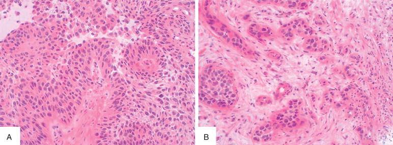 Figure 16-8, Frozen section showing a papillary urothelial carcinoma (A), characterized by abnormal urothelium with dysmaturation and cytologic atypia and fibrovascular stalks. Irregular, small aggregates of cytologically typical urothelial cells (B) are diagnostic of invasive urothelial carcinoma. Desmoplasia can be a clue.