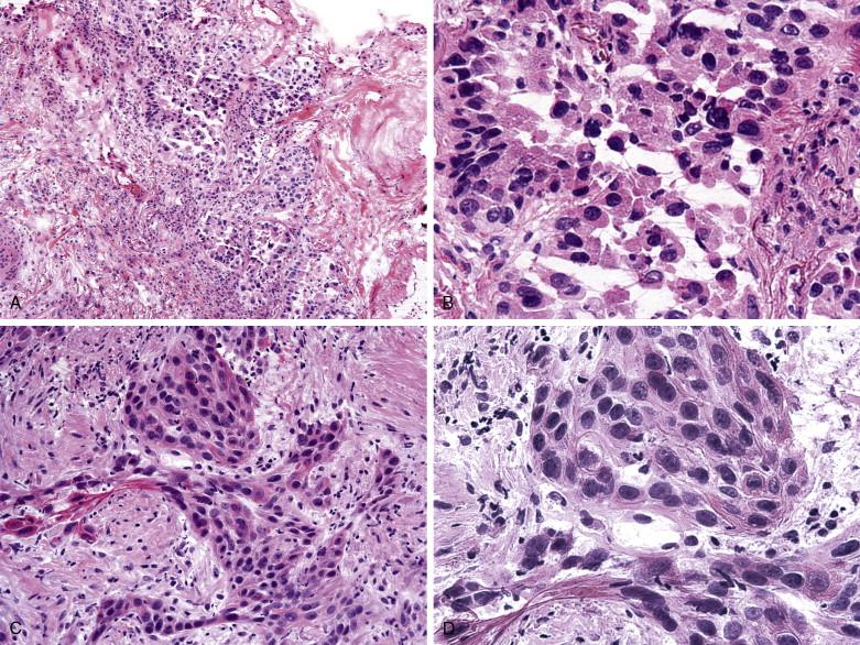 Figure 9-1, Metastatic non–small cell carcinoma to mediastinal lymph nodes. The diagnosis is generally straightforward. Thoracic surgeons do not need a characterization of specific cell type at the time of frozen section. A (x100) and B (x400) show metastatic adenocarcinoma. C (x200) and D (x400) show an example of metastatic squamous cell carcinoma.