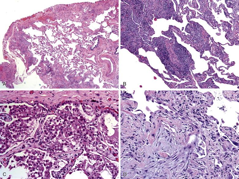 Figure 9-11, In patients with diffuse lung diseases, frozen sections are often performed to confirm the presence of adequate tissues and to help triage tissues. A, The frozen section (x40) shows an example of interstitial lung disease that may be difficult to classify; the pathologist should request additional tissues. B, An interstitial pneumonia (x40) could represent the cellular phase of nonspecific interstitial pneumonia (NSIP), an infectious atypical pneumonia and other conditions. The possibility of collecting tissues for immunofluorescence and/or cultures should be considered, depending on the clinical history. C, Numerous intraalveolar macrophages are shown (x100); if the patient has “alveolar filling defects” on imaging, the tissue is probably adequate. D, (x200) shows organizing pneumonia, probably adequate biopsy for diagnosis or postinfectious organizing pneumonia, cryptogenic organizing pneumonia, or other conditions.