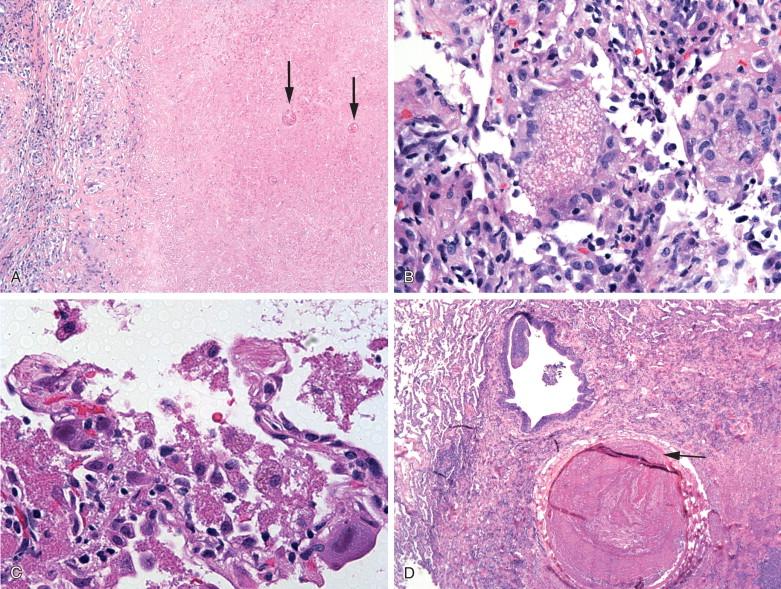 Figure 9-13, Other examples of intraoperative findings that would help initiate prompt therapy. A, A necrotizing granulomatous pneumonia (x40) with fungal forms consistent with Coccidioides sp. (arrows) . B (x200) and C (x400x) show the presence of foamy alveolar exudates in the frozen section from a patient with Pneumocystis jiroveci pneumonia. C also shows Cytomegalovirus-infected cells. D, (x40) shows a lung infarct with pulmonary embolus in a small pulmonary artery (arrow) .