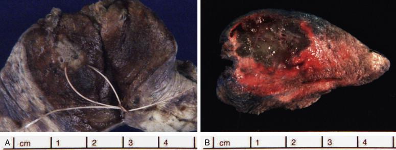 Figure 9-14, Adenocarcinoma in situ (AIS), nonmucinous type are usually difficult to find during gross inspection intraoperatively. A, They appear as ill-defined gray areas that have the same consistency as normal lung tissue. The lung tissues usually exude blood as soon as they are excised, so it is advisable for thoracic surgeons to mark the area of interest with sutures, as shown in A, or with another marker. B, An example of adenocarcinoma in situ, mucinous type, with a soft, gray, somewhat glistening surface.