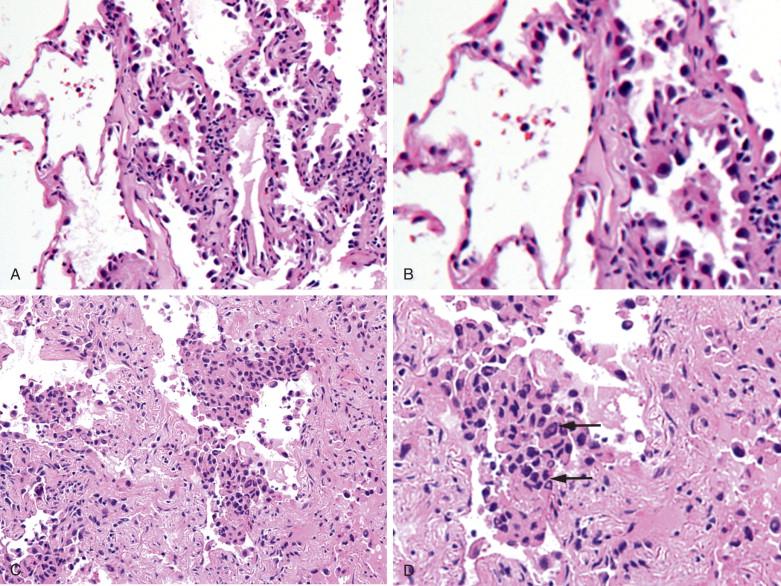 Figure 9-16, Adenocarcinoma in situ (AIS), nonmucinous type. The lesion usually shows no significant inflammation or thickening of alveolar septa and a distinct boundary, as shown in A (x100). The tumor cells are larger than normal pneumocytes, with high N:C ratio and frequent hobnail appearance, as shown in B (x200). The presence of nuclear stratification, seen in C (x200), is a useful feature for diagnosis. Another helpful but not pathognomonic feature is the presence of nuclear pseudoinclusions (arrow), seen in D (x400).