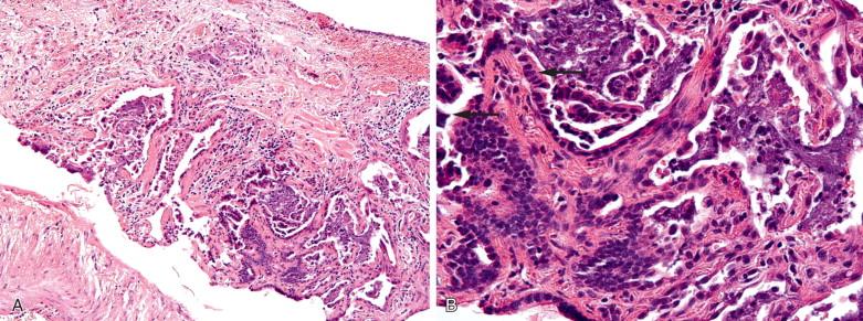 Figure 9-17, Peribronchial metaplasia needs to be distinguished from adenocarcinoma. A, The lesion tends to be localized around bronchioles (x100). B, The cells (x400) show features of bronchiolar epithelium, including the presence of cilia (arrows) .