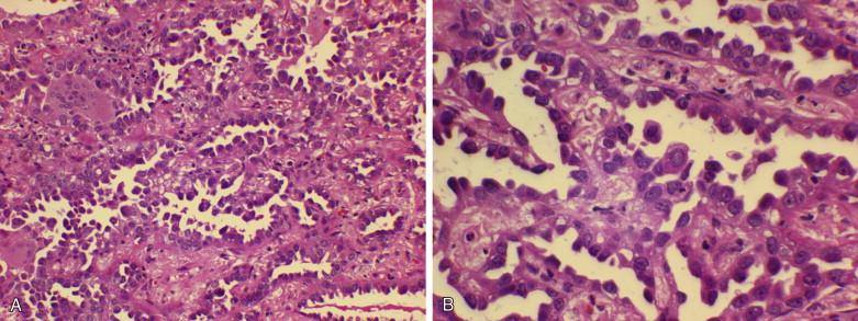 Figure 9-19, Micropapillary features of adenocarcinoma in situ of the lung ( A, x100; B, x400).