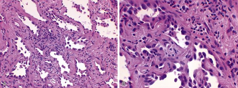 Figure 9-20, Adenocarcinoma in situ of the lung grows in a lepidic pattern without distorting the lung architecture ( A, x100; B, x400). Intranuclear pseudoinclusions are seen in B .