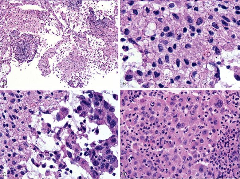Figure 9-2, Macrophages can be difficult to distinguish on frozen section from metastatic carcinoma. A, A lymph node with sinus histiocytosis (x100). B, At higher magnification (x400), some of the histiocytes exhibit anisocytosis and enlarged nuclei. C, The contrast is shown between the cytologic features of histiocytes on the left with those of the larger, more cohesive, and markedly more atypical metastatic carcinoma cells on the right (x200). D, This illustrates another case of metastatic carcinoma (x400), where the neoplastic cells could be overlooked as they exhibit low N:C ratio and are closely admixed with inflammatory cells.