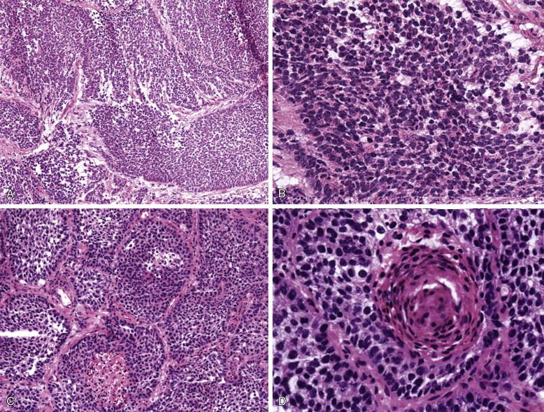 Figure 9-3, Carcinoid tumor can be difficult to distinguish from non–small cell carcinoma on frozen section. A, (x100) shows a metastatic carcinoid tumor to a mediastinal lymph node. B, The tumor cells, shown at higher magnification (x400), are organized in cellular nests. C, (x100) shows a metastatic squamous cell carcinoma to a mediastinal lymph node with nesting pattern similar to that seen in A. Further examination of this lesion allows for the detection of higher mitotic activity, and of a keratin pearl, shown in D (x400), diagnostic of a metastatic squamous cell carcinoma.