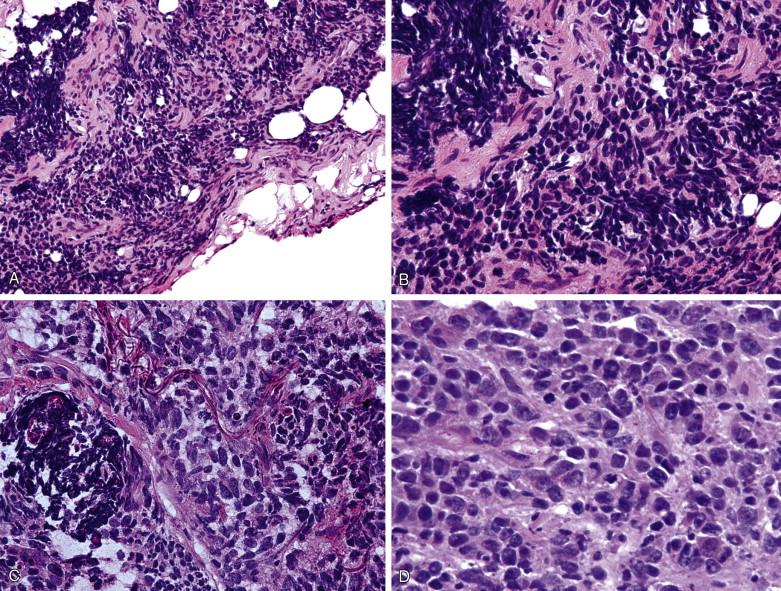 Figure 9-4, A, Lymphocytes (x100) can become “crushed” raising the question of metastatic small cell carcinoma to mediastinal lymph nodes. B, The frozen section needs to be examined carefully looking for better preserved areas (x400). In contrast, C (x400) and D (x400) show examples of metastatic small carcinoma to mediastinal lymph nodes with “crush” artifact. The tumor cells are at least two times larger than lymphocytes and exhibit nuclear molding and a “salt-and-pepper” chromatin pattern, rather than the coarse granular chromatin pattern seen in lymphoid cells.