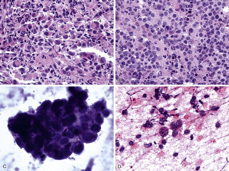 Figure 9-6, Large cell lymphoma can be difficult to distinguish from metastatic carcinoma to mediastinal lymph nodes. A, A metastatic poorly differentiated non–small cell carcinoma (x400). B, A large cell lymphoma (x400). The two cases share some cytologic features, although the cells of the carcinoma have more abundant and somewhat eosinophilic cytoplasm. C, Touch preparations are helpful to show that the carcinoma cells (x400) form cohesive cellular clusters composed of large cells with hyperchromatic nuclei and cytoplasm with well-defined cellular borders. D, The lymphoma cells (x400) are discohesive and exhibit somewhat irregular nuclear shape, cytoplasm with indistinct cellular borders, high N:C ratio, and granular chromatin.