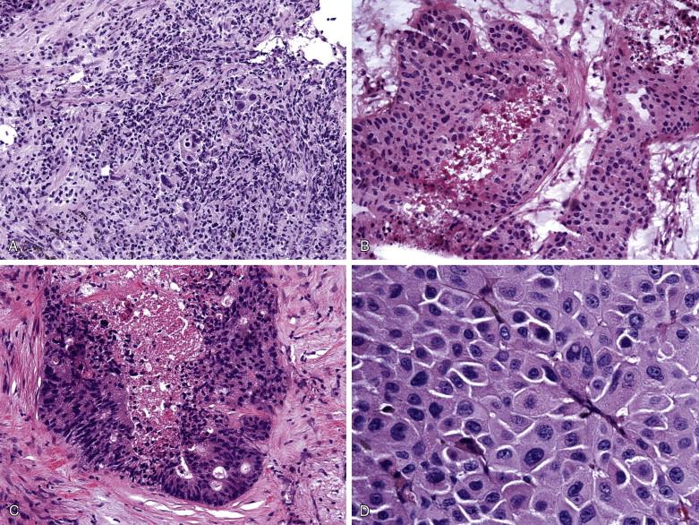 Figure 9-7, A variety of neoplasms can metastasize to mediastinal lymph nodes, including pulmonary non–small cell carcinoma ( A, x100), ductal carcinoma of breast ( B, x200), colonic adenocarcinoma ( C, x200) and malignant melanoma ( D, x400).