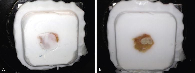 Figure 9-9, It is important to trim tissues appropriately during preparation of frozen sections. Slides cut from the example shown in A would have underrepresented the entire lymph node shown after further tissue trimming in B. In our experience, this is a frequent source of false-negative frozen sections performed for lung cancer.