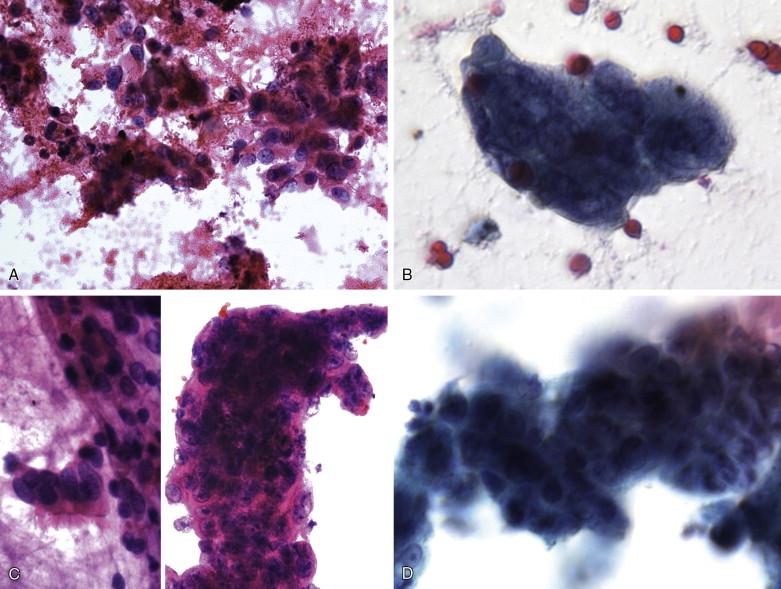 Figure 9-10, EBUS-TBNA is a procedure being performed with increasing frequency for lung cancer mediastinal staging. Its sensitivity and specificity for the diagnosis of metastatic carcinoma to mediastinal lymph nodes is only slightly lower than those of mediastinoscopy. A-D ( x400) show examples of metastatic non–small cell carcinoma diagnosed with this procedure. A, B, squamous cell carcinoma; C, D, adenocarcinoma.