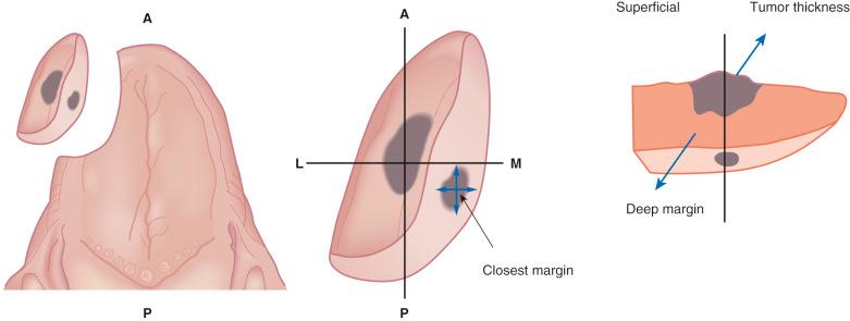 Fig. 7-1, Resection specimen and surgical margins.
