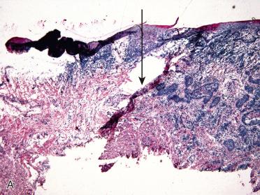 Fig. 7-3, Resection margins.