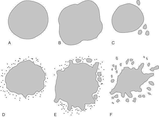 Fig. 21-1, Configuration of benign and malignant salivary gland neoplasms.