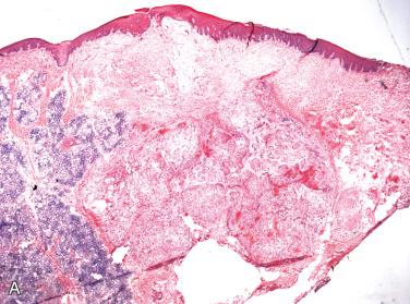 Fig. 21-12, Polymorphous low-grade adenocarcinoma.