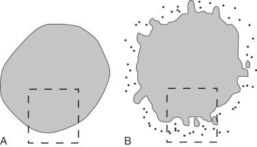 Fig. 21-2, Appropriate sectioning of salivary gland neoplasms.