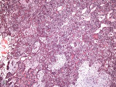 Fig. 21-5, Cellular pleomorphic adenoma.