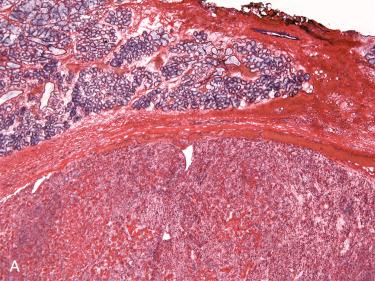 Fig. 21-6, Myoepithelial-predominant PA.