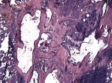 Fig. 21-9, Mucoepidermoid carcinoma, low-grade.