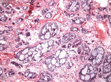 Fig. 21-10, Adenoid cystic carcinoma.