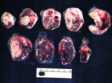 Figure 6-1, Sectioning of the thyroid lobe. After quick weighing and inking, the lobe is serially sectioned coronally from superior to inferior to reveal a large ill-defined nodule with heterogenous cut surfaces. Smears and one frozen section will be made from a representative area of the nodule.