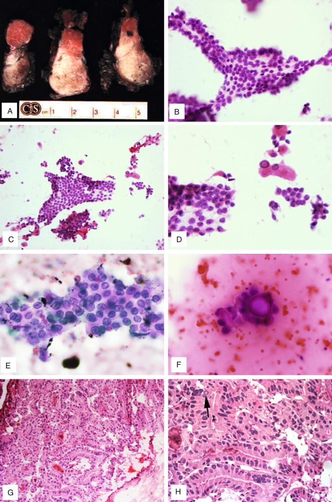 Figure 6-2, Papillary thyroid carcinoma, classical type. A , Most papillary carcinomas are solid, firm and pale to white with poorly defined margins. B-F , Smears are usually cellular showing classic features of PTC including papillary architecture, nuclear enlargement, nuclear overlapping, nuclear grooves, intranuclear pseudoinclusions, squamoid change (B and D, x400, C, x200, E, x600) and psammoma bodies (F, x600). G-H , Papillary architecture is evident even at low magnification (G, x100); nuclear overlapping and elongation and rare intranuclear pseudoinclusions ( arrow , H, x400) are noted on frozen sections at higher magnification.