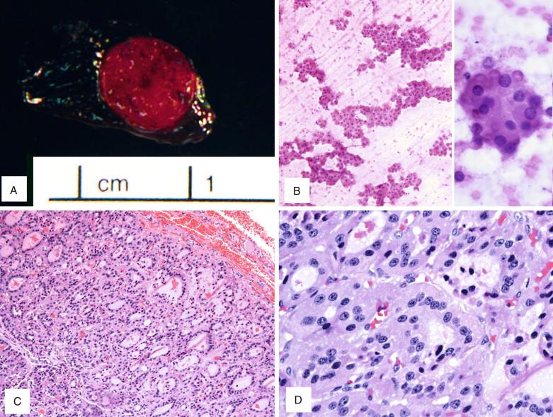 Figure 6-3, Follicular adenoma (Hürthle cell variant). A , A well-circumscribed and thinly encapsulated round nodule with solid and homogeneous cut surface. B , A cellular smear consisting of clusters of bland Hürthle cells in a background of abundant colloid without nuclear features of PTC ( left , x100, right , x600). C-D , Frozen section showing tumor composed of small to medium-sized follicles surrounded by a thin capsule (C, x100), and higher magnification showing follicles formed by Hürtle cells (D, x400).