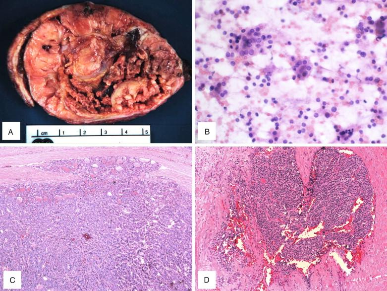 Figure 6-4, Minimally invasive follicular carcinoma. A , Gross cut surface of the tumor with a slightly irregularly thickened capsule, focal hemorrhagic and cystic change. B , Cellular smear with small clusters and microfollicles of bland follicular cells in a background of minimal colloid (x400). C-D , Focal capsular (C, x100) and vascular invasions (D, x100) identified on frozen sections.