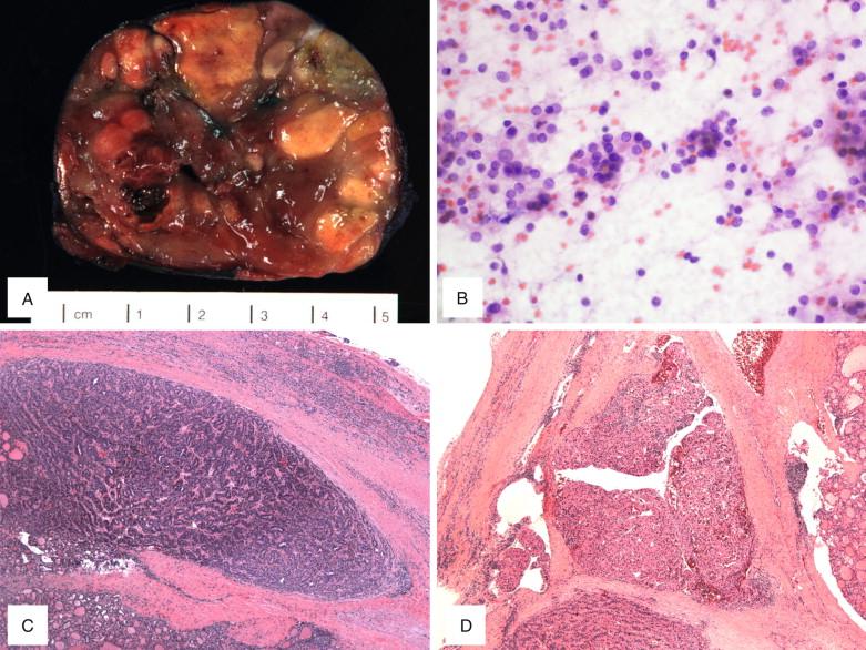 Figure 6-5, Widely invasive follicular carcinoma. A , Gross cut surface of the tumor with a partial capsule and heterogenous focally nodular appearance. B , Cellular smear with small clusters and microfollicles of bland follicular cells in a background of minimal colloid (x400). C-D , Extensive capsular invasion in multiple areas (C, x40) and vascular invasion involving four vessels (D, x40) by tumor identified on frozen sections.