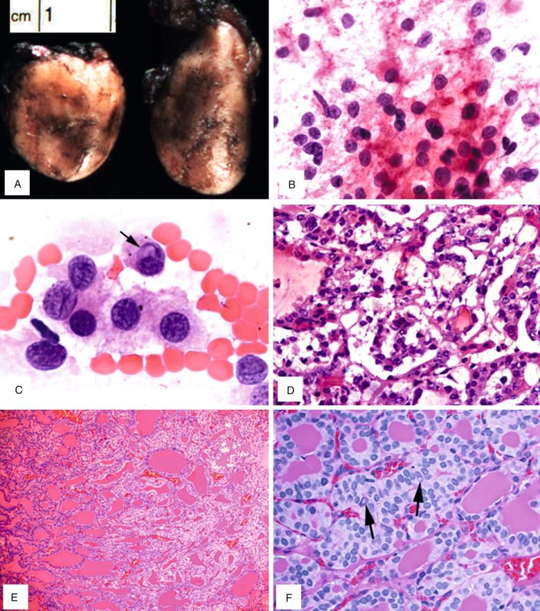 Figure 6-8, Papillary thyroid carcinoma, follicular variant. A , Gross cut surface of a well-circumscribed and thinly encapsulated nodule with a homogenous tan cut surface. B-D , Few nuclear grooves and one probable intranuclear inclusion ( arrow , C) noted on smear preparation (B, x600; C, x800) but inapparent on frozen section because of freezing artifact (D, x400). E , Tumor composed of medium-sized follicles with a pale area noted at a lower magnification (x100). F , Features of PTC better appreciated at a higher magnification (x400, arrow for rare intranuclear pseudoinclusions on permanent section.