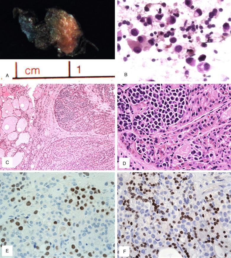 Figure 6-9, Metastatic breast lobular carcinoma into a benign Hürthle cell nodule. A , A small ill-defined lesion with homogenous tan-brown cut surface. B , Rare signet ring cell in a background of some Hürthle cells (x600) on smear. C-D , Tumor cells in clusters and single cell forms with plasmacytoid and focally signet-ring cell features seen in a Hürthle cell nodule on frozen section (C, x100; D, x400). E-F , Tumor cells immunohistochemically positive for estrogen receptor (E, x400) but negative for TTF-1 (F, x400).